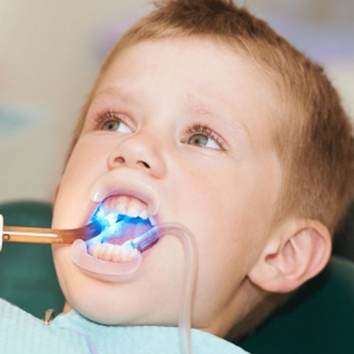 Trám răng sữa bị sâu