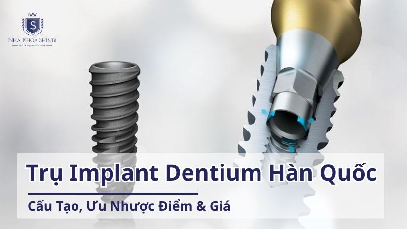 Trụ Implant Dentium: Tìm Hiểu Xuất Xứ, Cấu Tạo và Mức Giá
