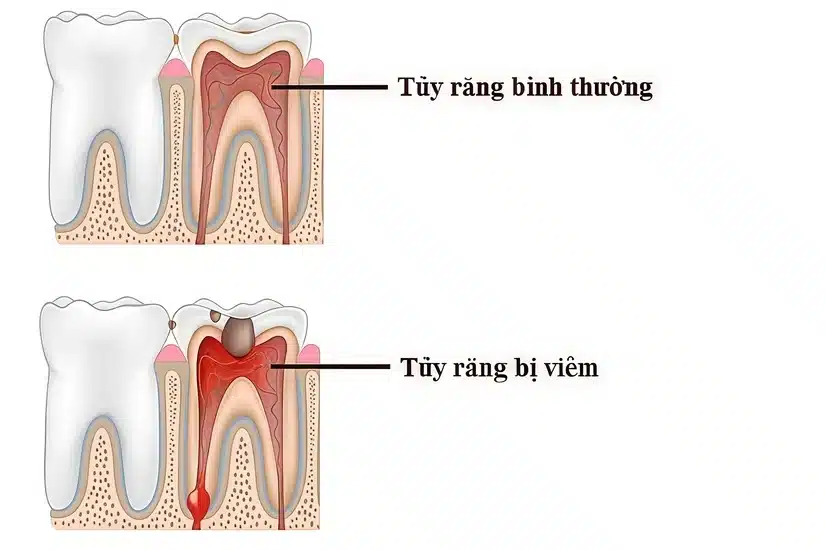 Viêm tủy răng có nguy hiểm không? 7 dấu hiệu cần biết
