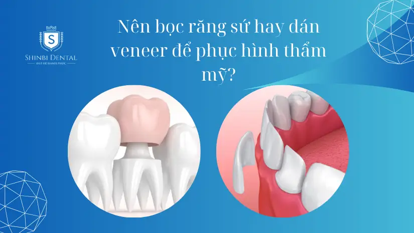 Nên bọc răng sứ hay dán veneer để phục hình thẩm mỹ?