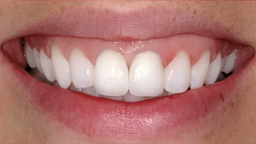 Bọc răng sứ cho răng cửa bị hô được không? Giá và quy trình