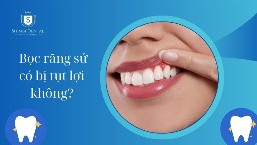 Bọc răng sứ có bị tụt lợi không? Cách khắc phục