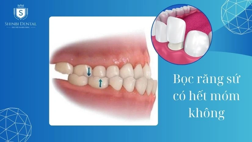 Bọc răng sứ có hết móm không? Cách điều trị hiệu quả