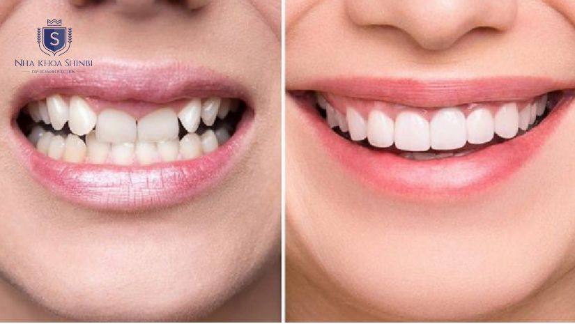 Bọc răng sứ khớp cắn ngược có nên hay không? Cách điều trị?