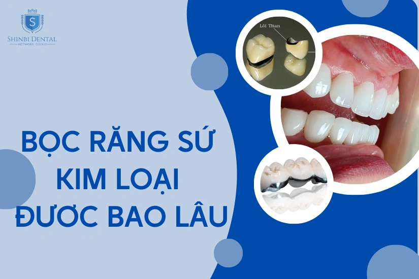 Bọc răng sứ kim loại được bao lâu? Cách kéo tuổi thọ răng