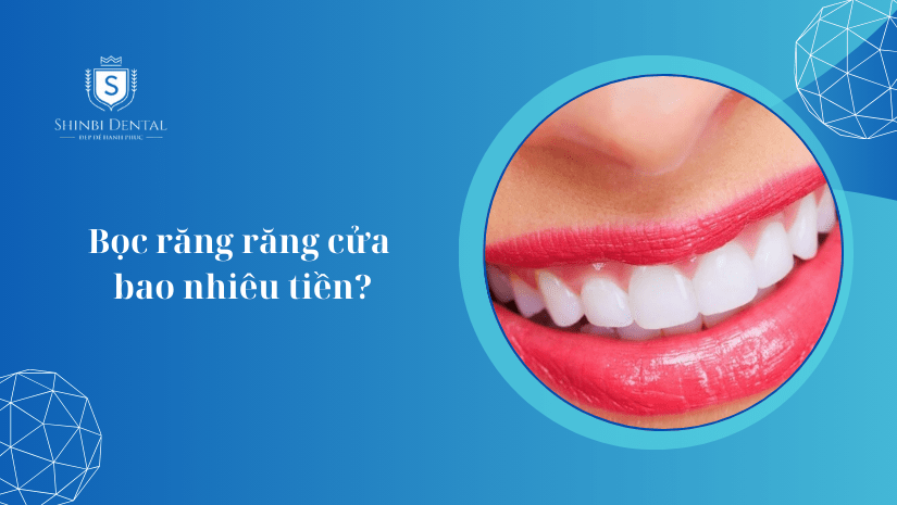 Chi phí bọc sứ răng cửa bao nhiêu tiền? Bảng giá 2025