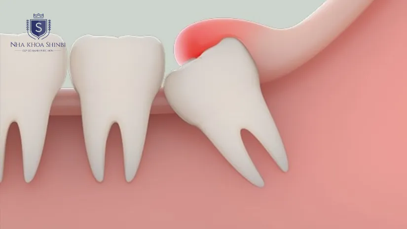 Chi phí nhổ răng khôn hết bao nhiêu tiền trọn gói?
