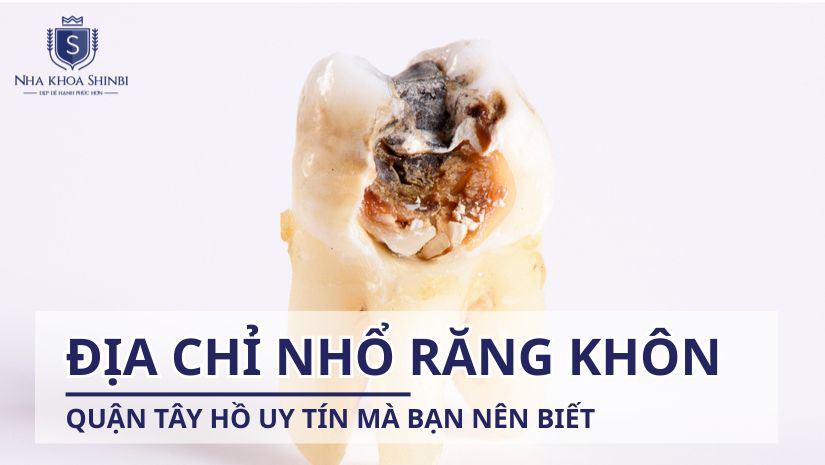 Địa chỉ nhổ răng khôn quận Tây Hồ uy tín mà bạn nên biết