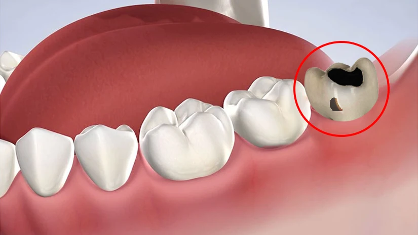 Giá nhổ răng khôn bị sâu bao nhiêu tiền? Bảng giá