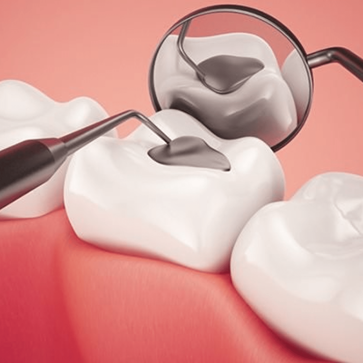 Hàn trám bít lỗ rãnh sâu nhỏ, răng sữa