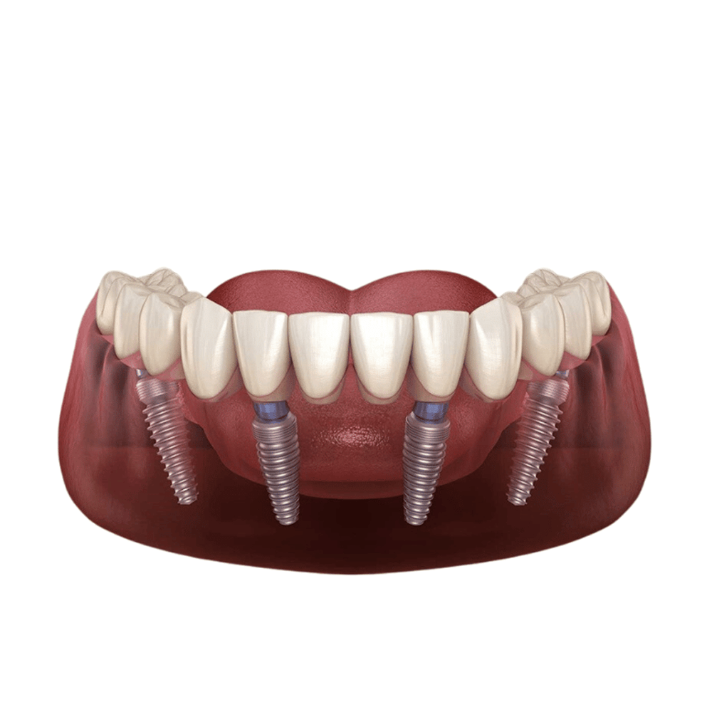 Implant All on 4 Hàn Quốc