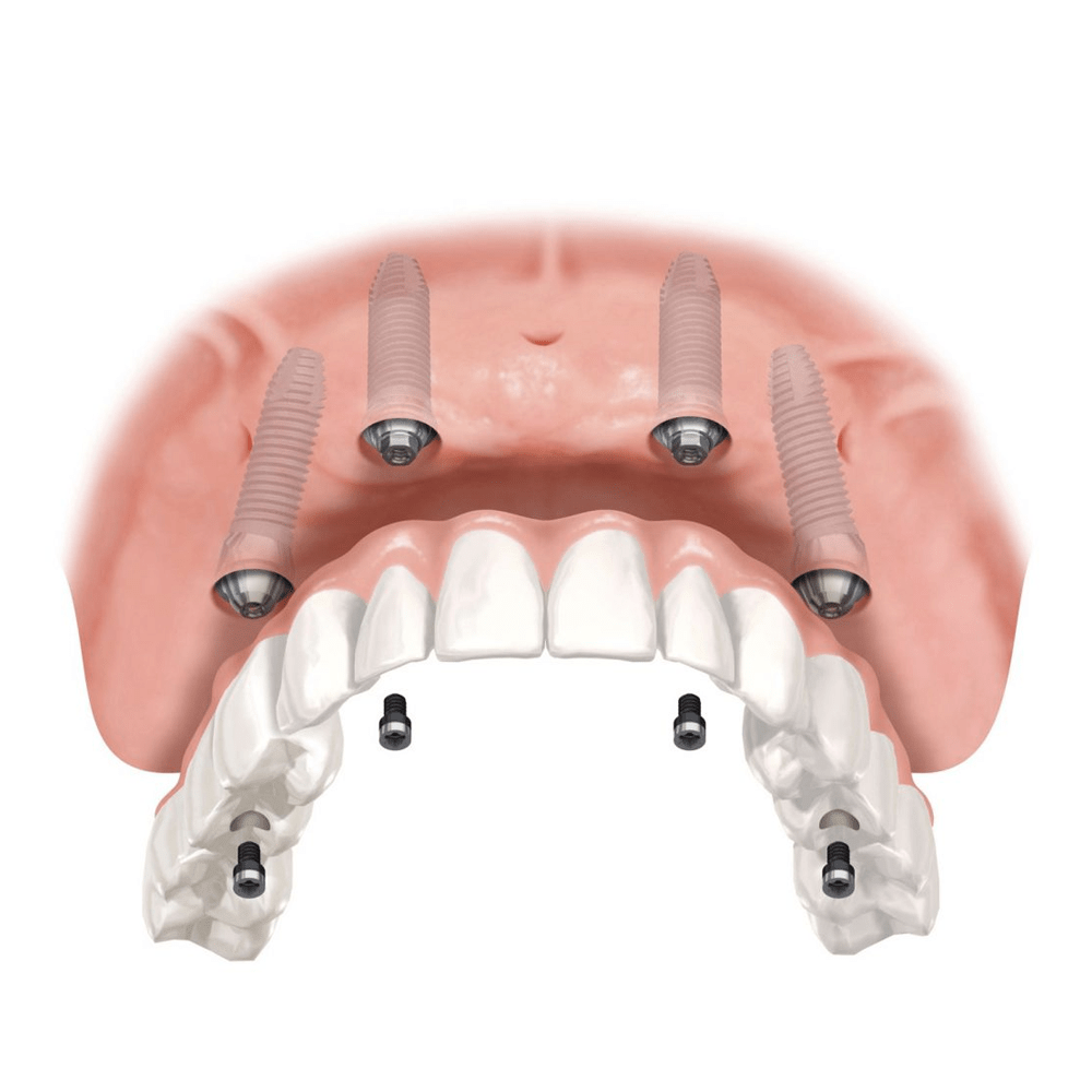 Implant All on 4 Thụy Sĩ