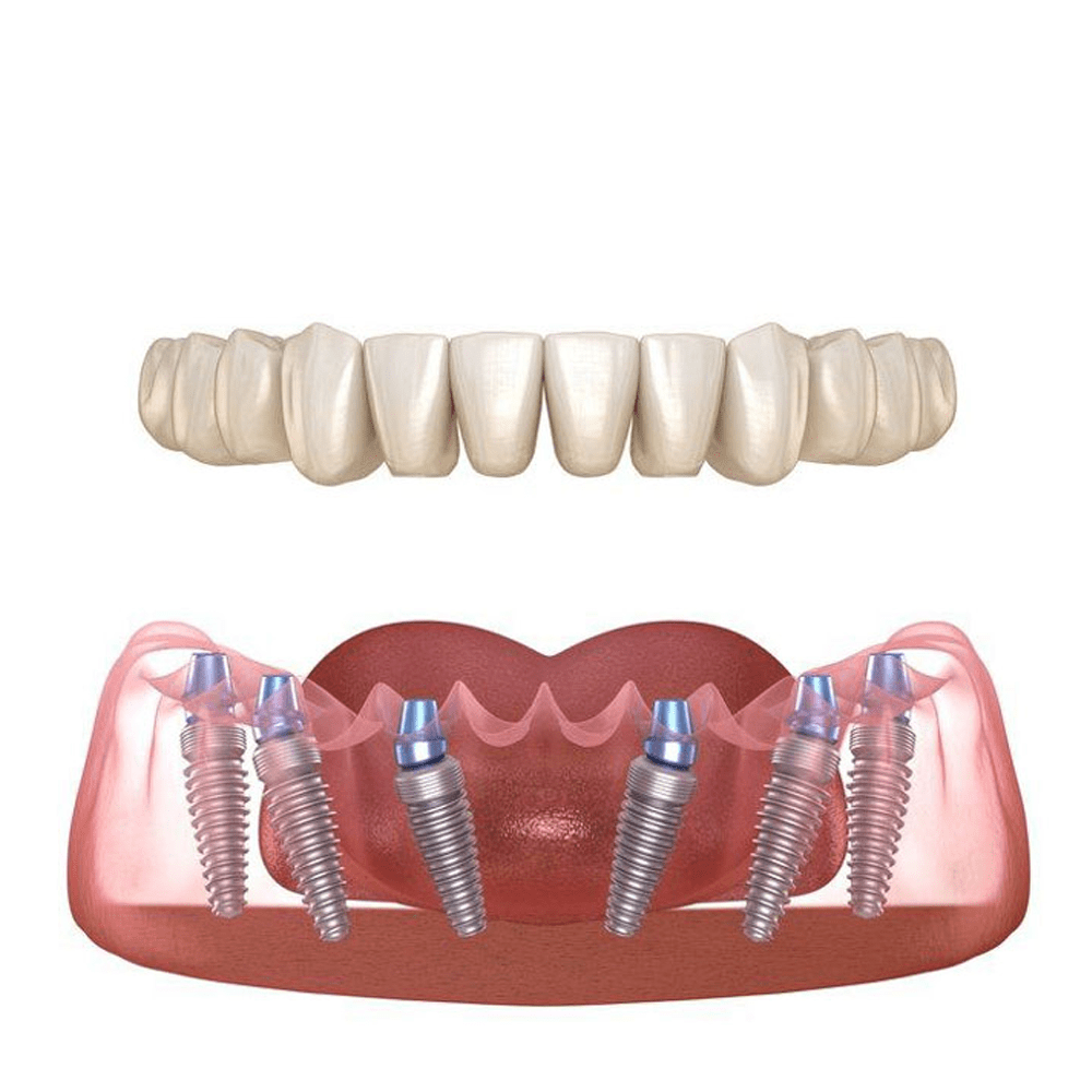 Implant All on 6 Thụy Sĩ