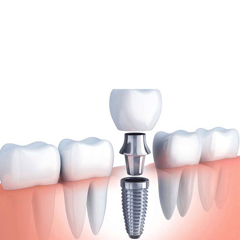 Trụ Implant Hiosen Mỹ