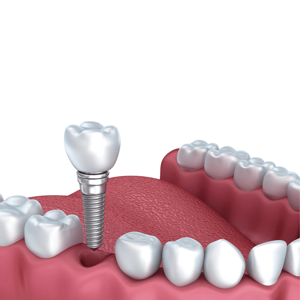 Trụ Implant Neodent (Thụy Sĩ)