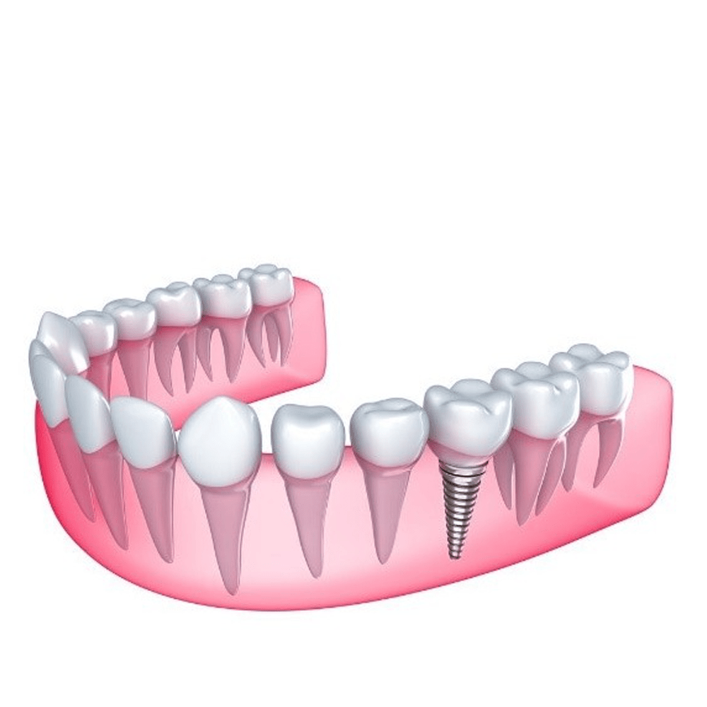 Trụ Implant Nobel (Mỹ)