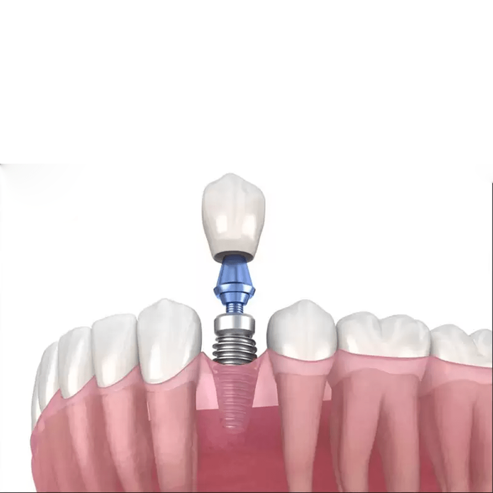 Trụ Implant Osstem Hàn quốc