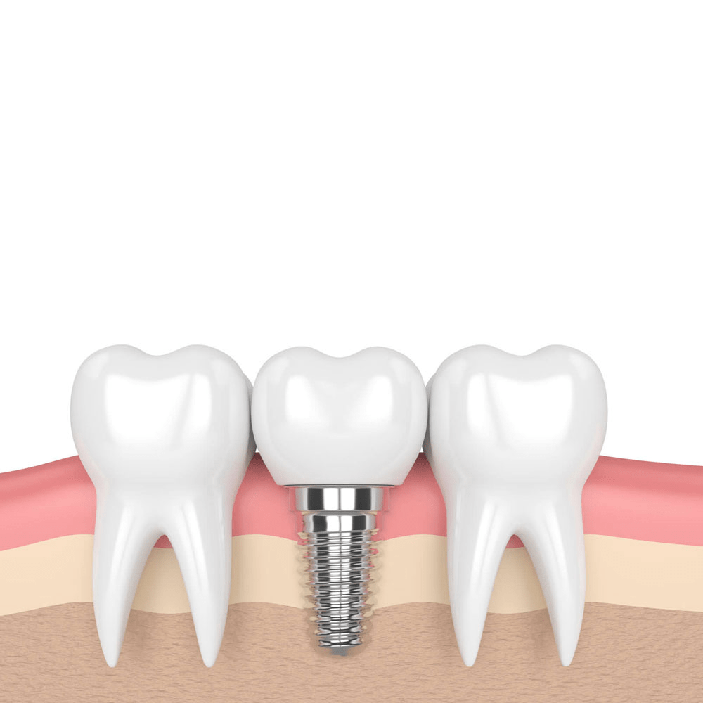Trụ Implant Straumann BLX Thụy Sĩ
