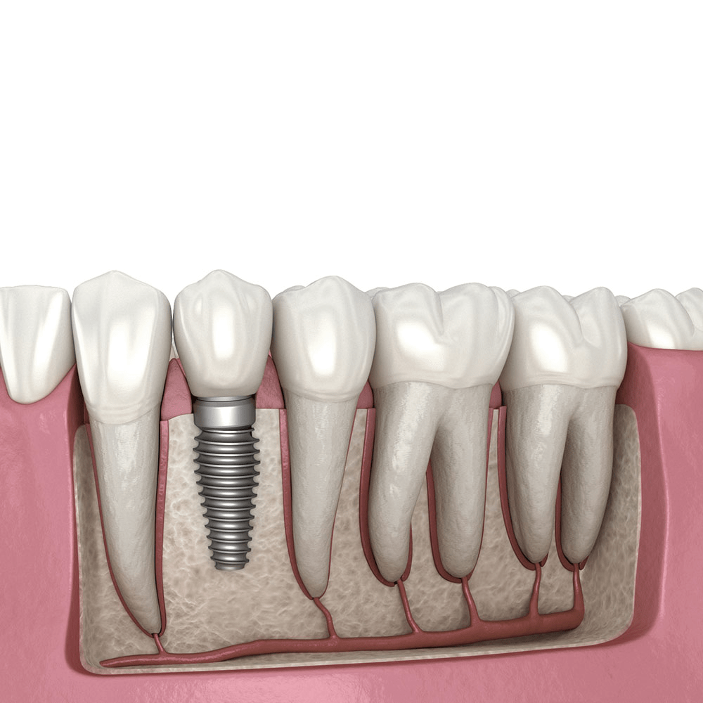 Trụ Implant Straumann Thụy Sĩ