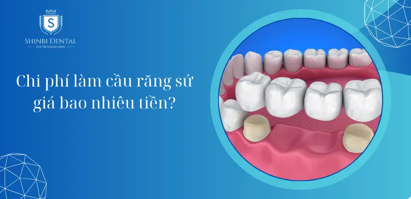 Chi phí làm cầu răng sứ giá bao nhiêu tiền? Bảng giá