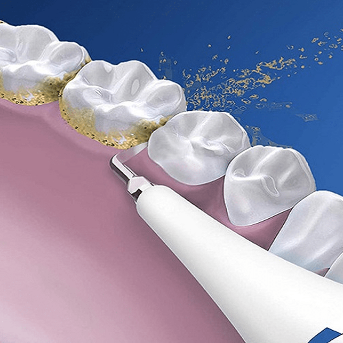 Lấy cao răng bằng máy công nghệ cao