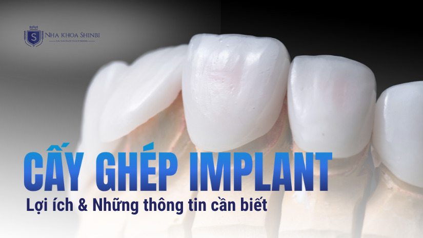 Lợi ích cấy ghép Implant và những thông tin bạn nên biết