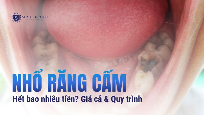 Nhổ răng cấm bao nhiêu tiền? Giá cả và Quy trình tại Shinbi