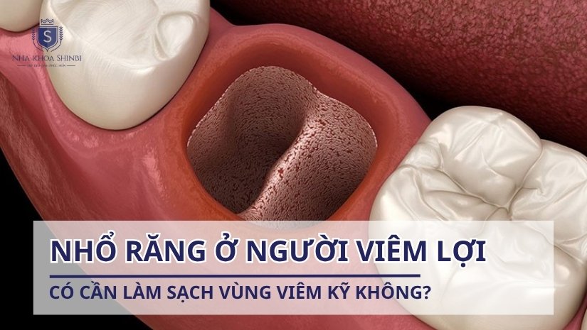 Nhổ răng ở người viêm lợi có cần làm sạch vùng viêm kỹ không