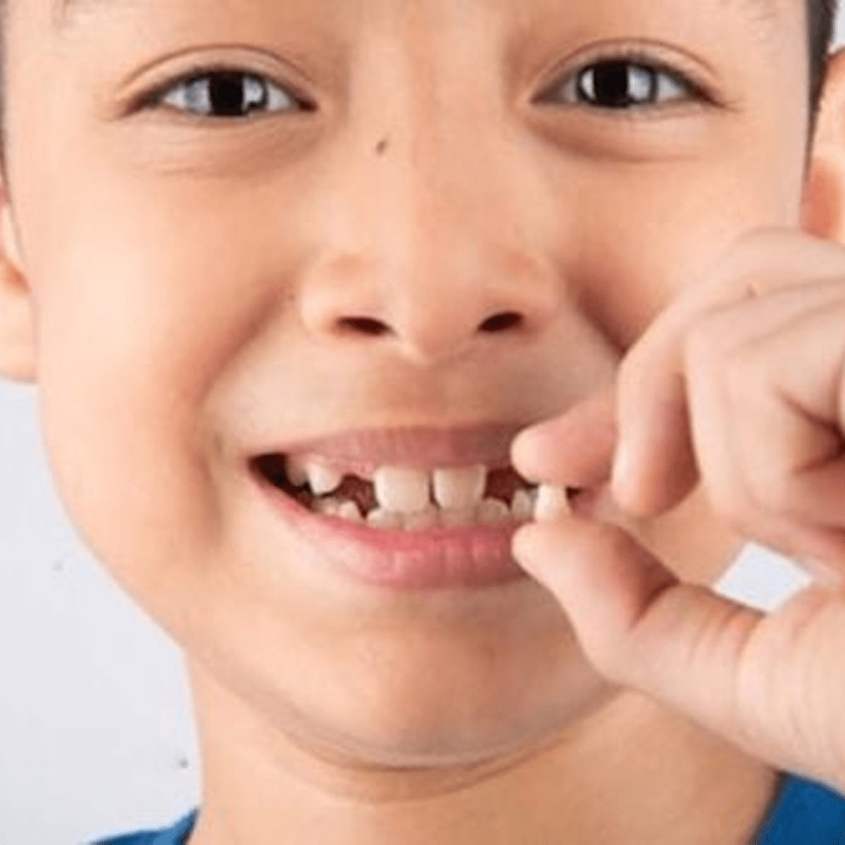 Nhổ răng sữa tiêm tê