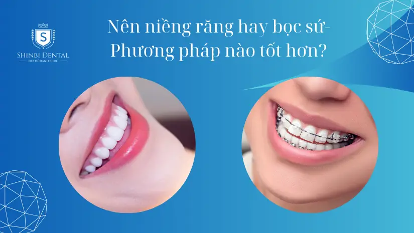 Nên niềng răng hay bọc sứ răng cái nào tốt hơn?