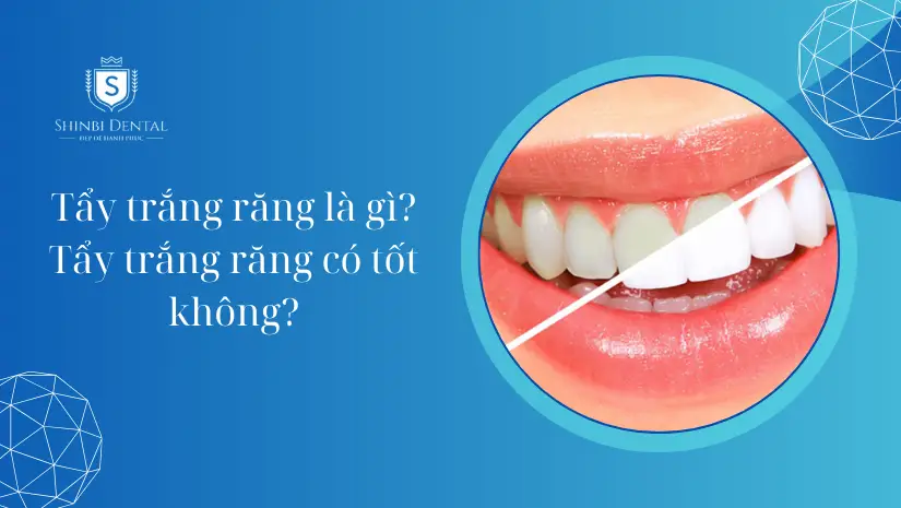 Tẩy trắng răng là gì? Các phương pháp và Lưu ý
