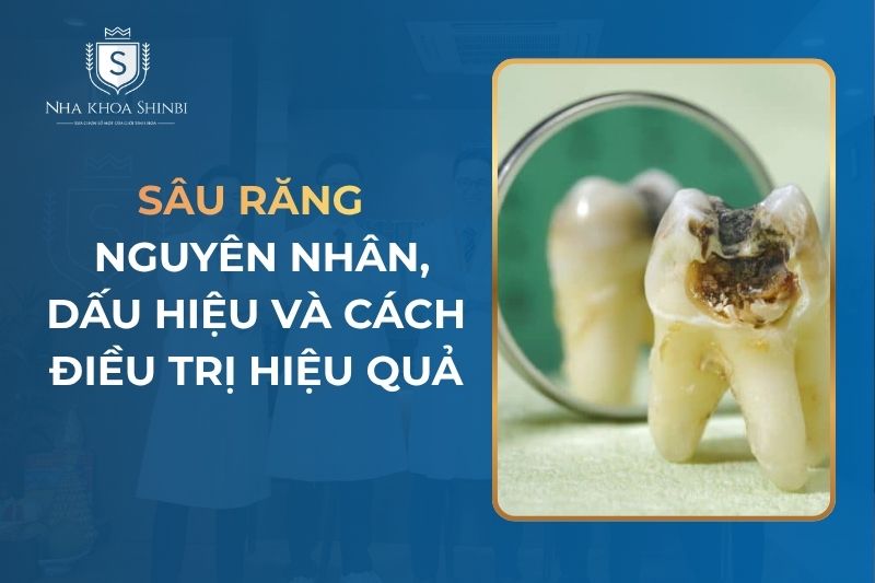 Sâu răng: Nguyên nhân, dấu hiệu và cách điều trị hiệu quả