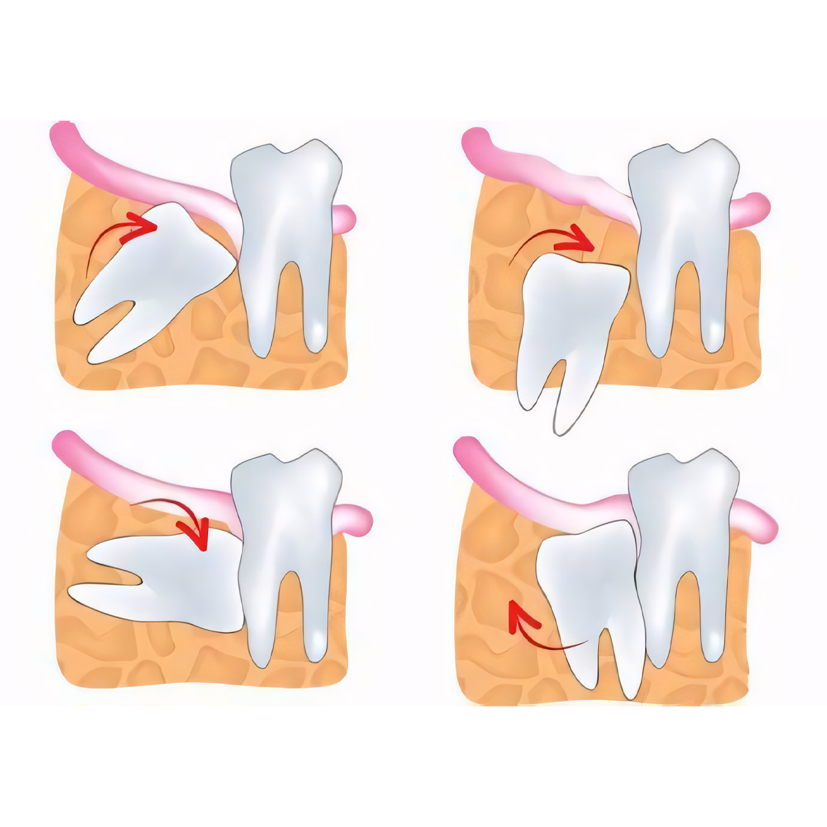 Nhổ răng 8 hàm trên mọc lệch