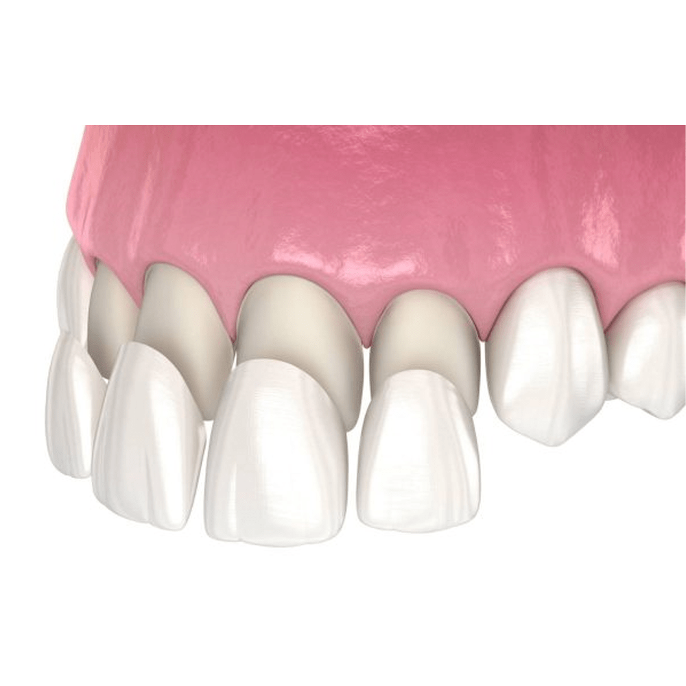 Dán sứ 3D Promax