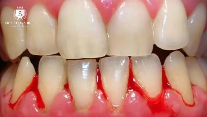 Tổng hợp các tác hại bọc răng sứ trước khi quyết định làm