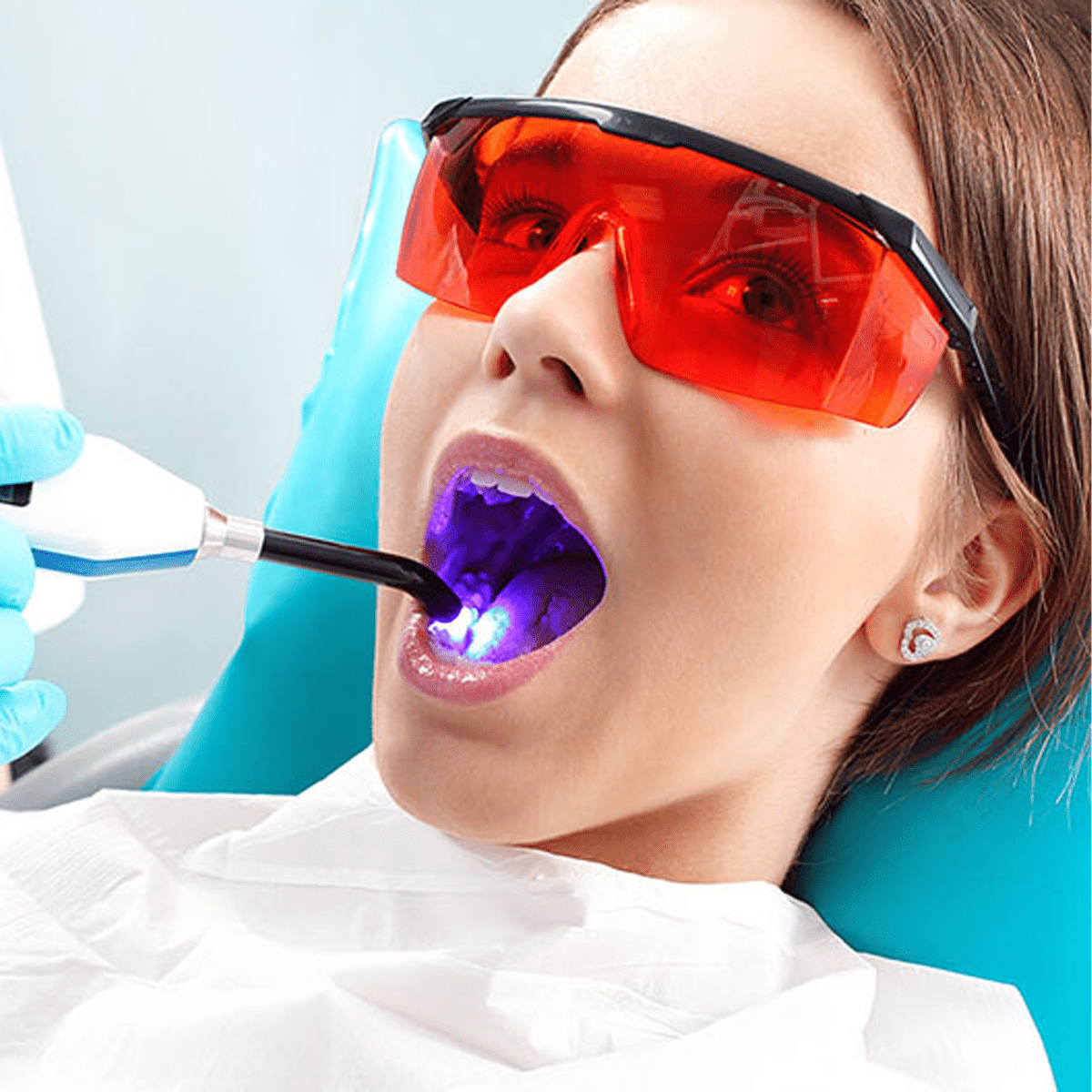 Tẩy trắng răng laser