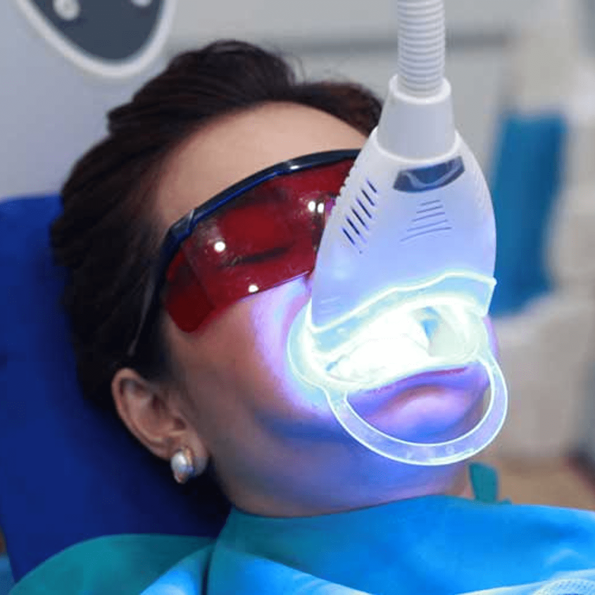 Tẩy trắng răng bằng máy công nghệ cao
