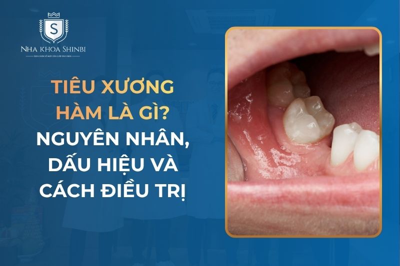Tiêu Xương Hàm Là Gì? Nguyên Nhân, Dấu Hiệu Và Cách Điều Trị