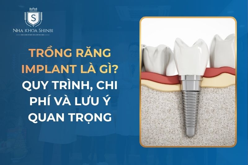 Trồng Răng Implant Là Gì? Quy Trình, Chi Phí và Lưu Ý