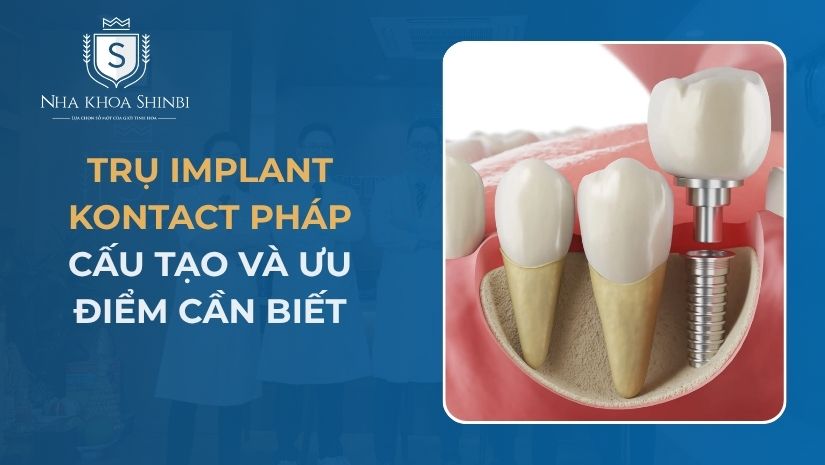 Trụ Implant Kontact Pháp: Cấu Tạo Và Ưu Điểm Cần Biết