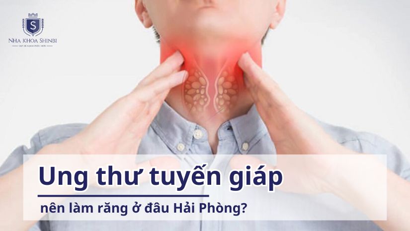 Ung thư tuyến giáp nên làm răng ở đâu tại Hải Phòng?