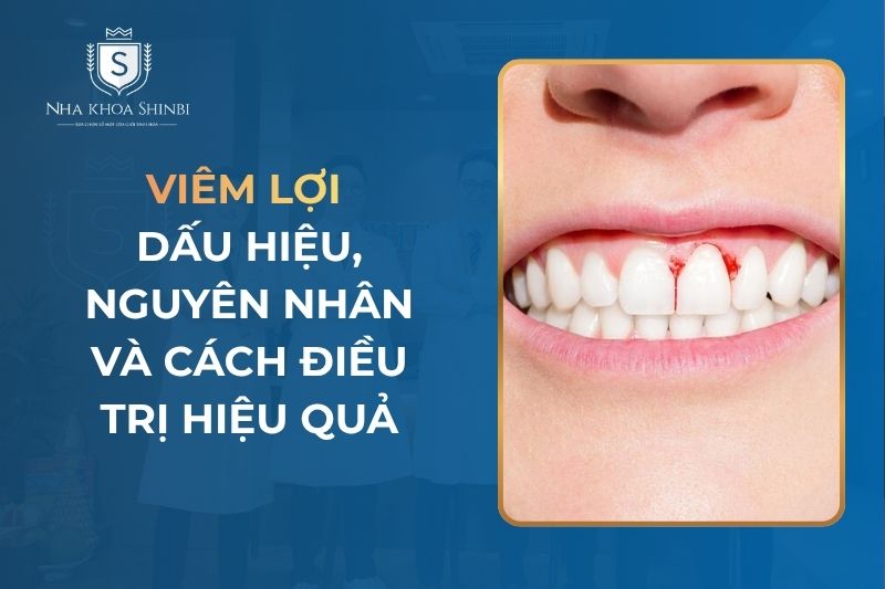 Viêm Lợi: Dấu Hiệu, Nguyên Nhân Và Cách Điều Trị Hiệu Quả