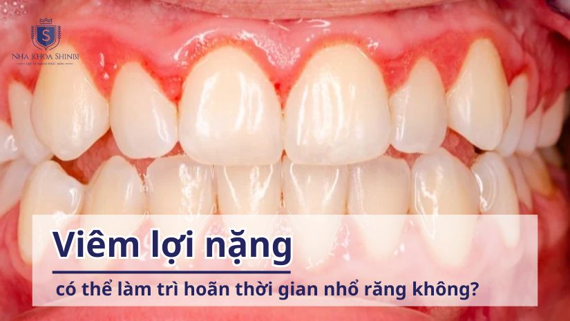 Viêm lợi nặng có thể làm trì hoãn thời gian nhổ răng không?