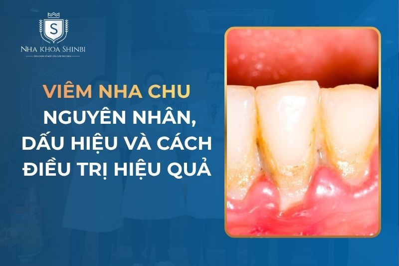 Viêm Nha Chu: Nguyên Nhân, Dấu Hiệu Và Cách Điều Trị Hiệu Quả